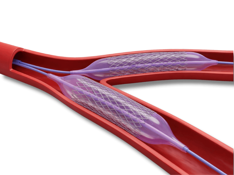Ilustração — Angioplastia